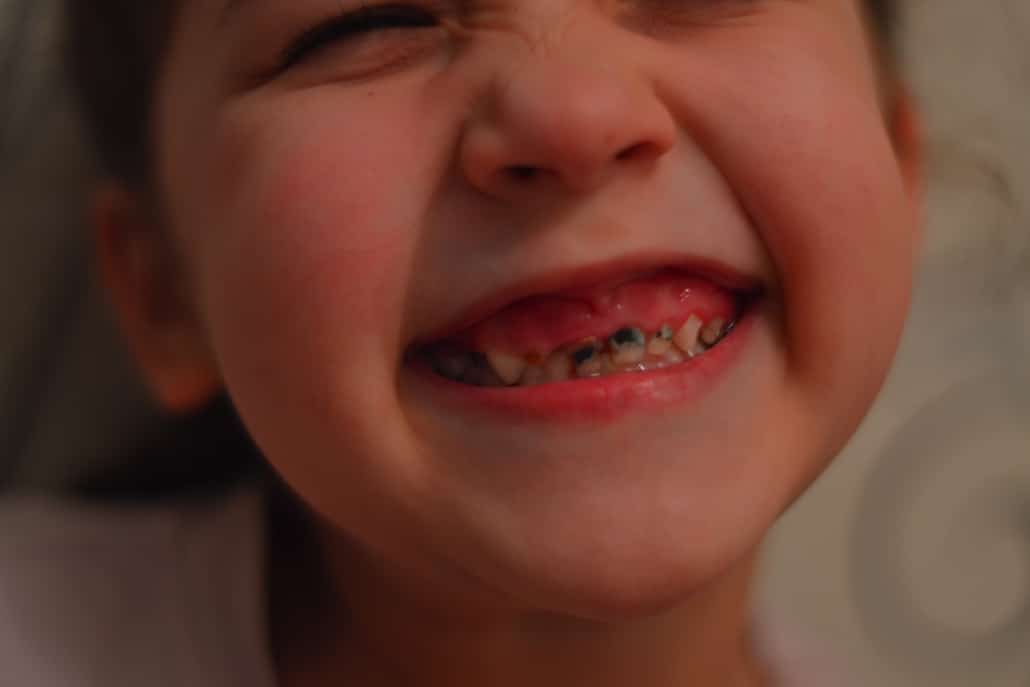 Front Tooth Decay